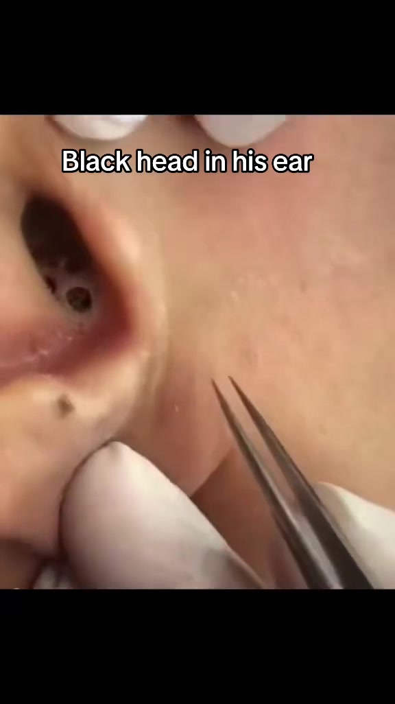@Satisfying Ear Cleaning Videos