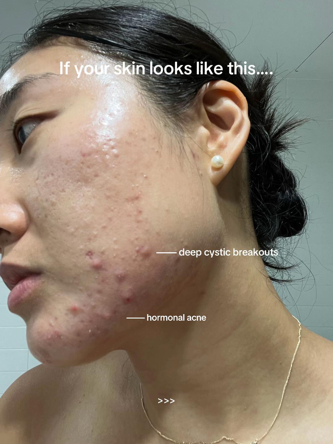 @Lisa | acne &rarr; clear skin