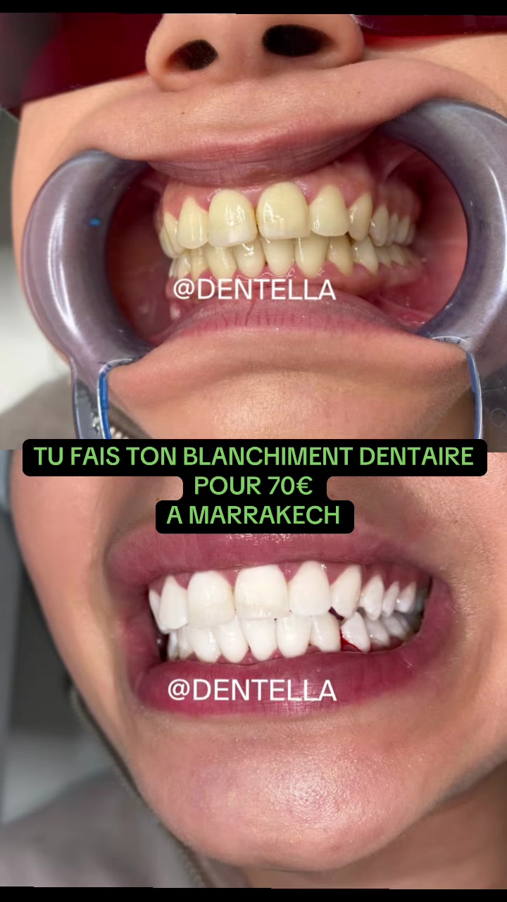 @Dentella