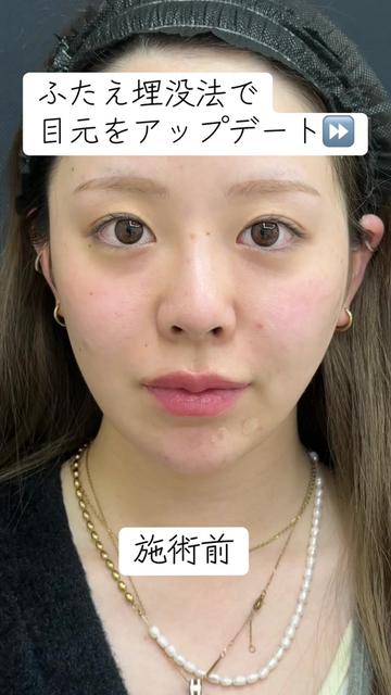 @二重整形埋没法/広島美容外科メイプルクリニック院長　吉本如良