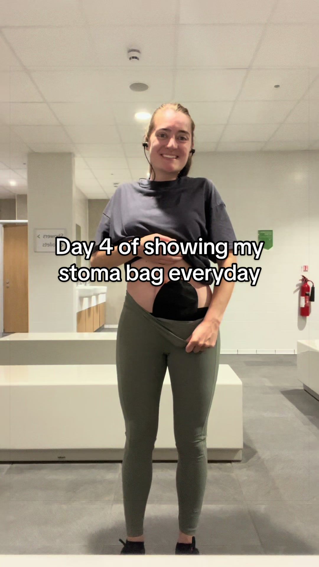 @Louise | Stoma & Crohns