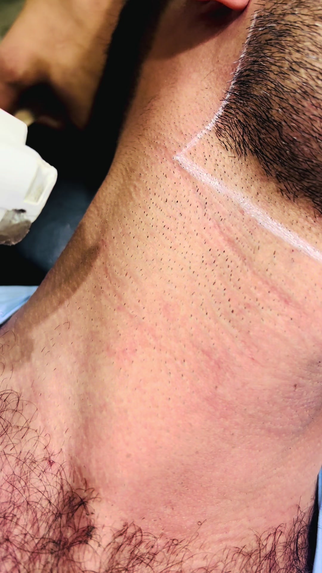 @Laser Grafix clinic