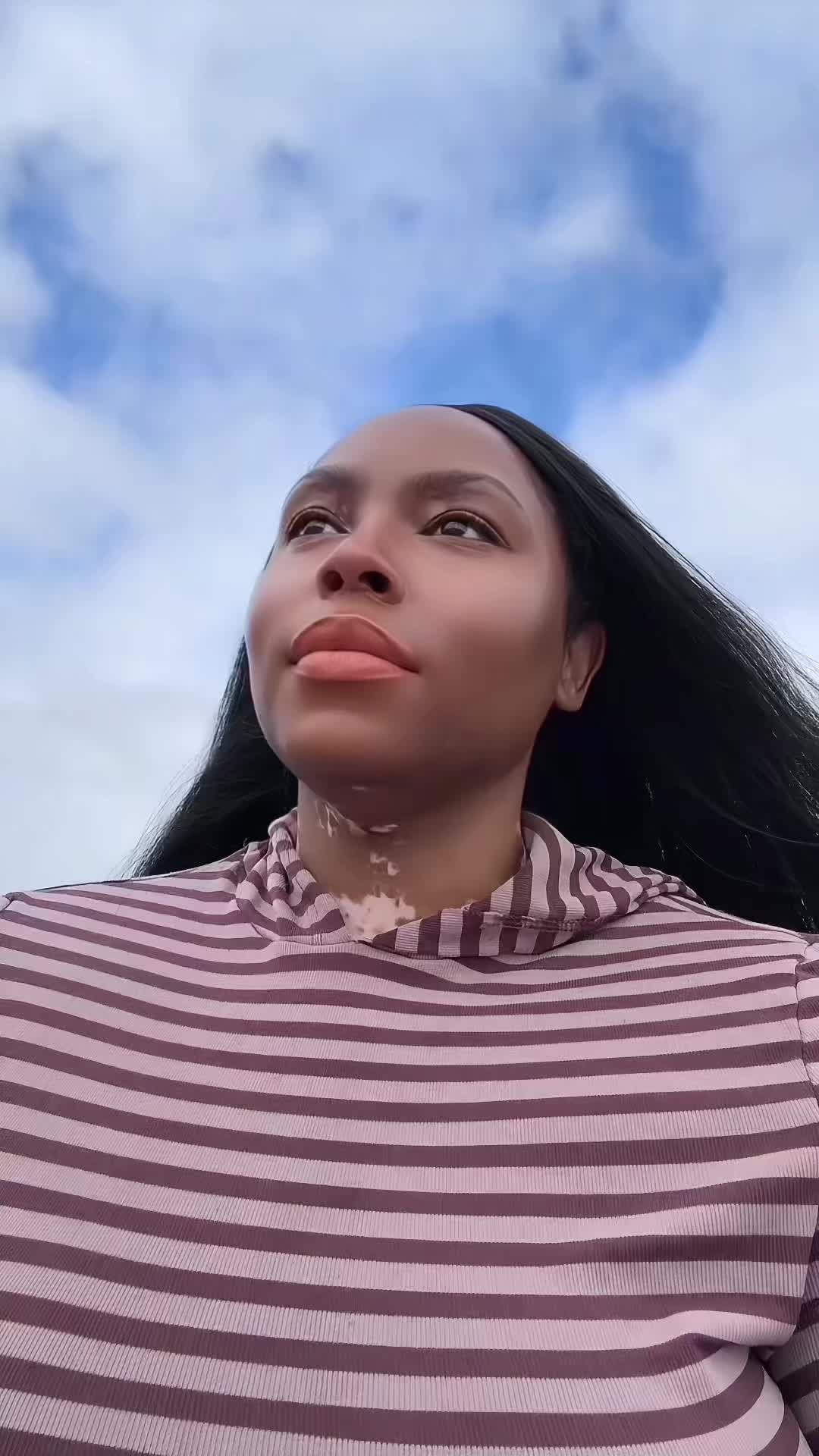 @VitiligoFairy