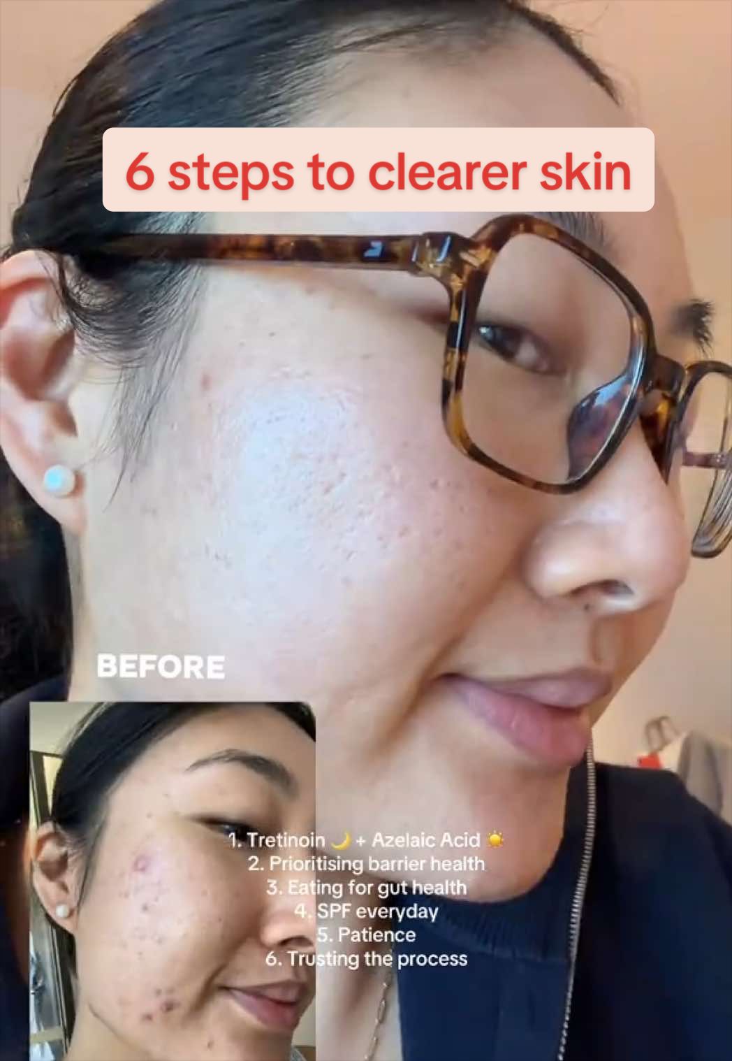 @Lisa | acne → clear skin