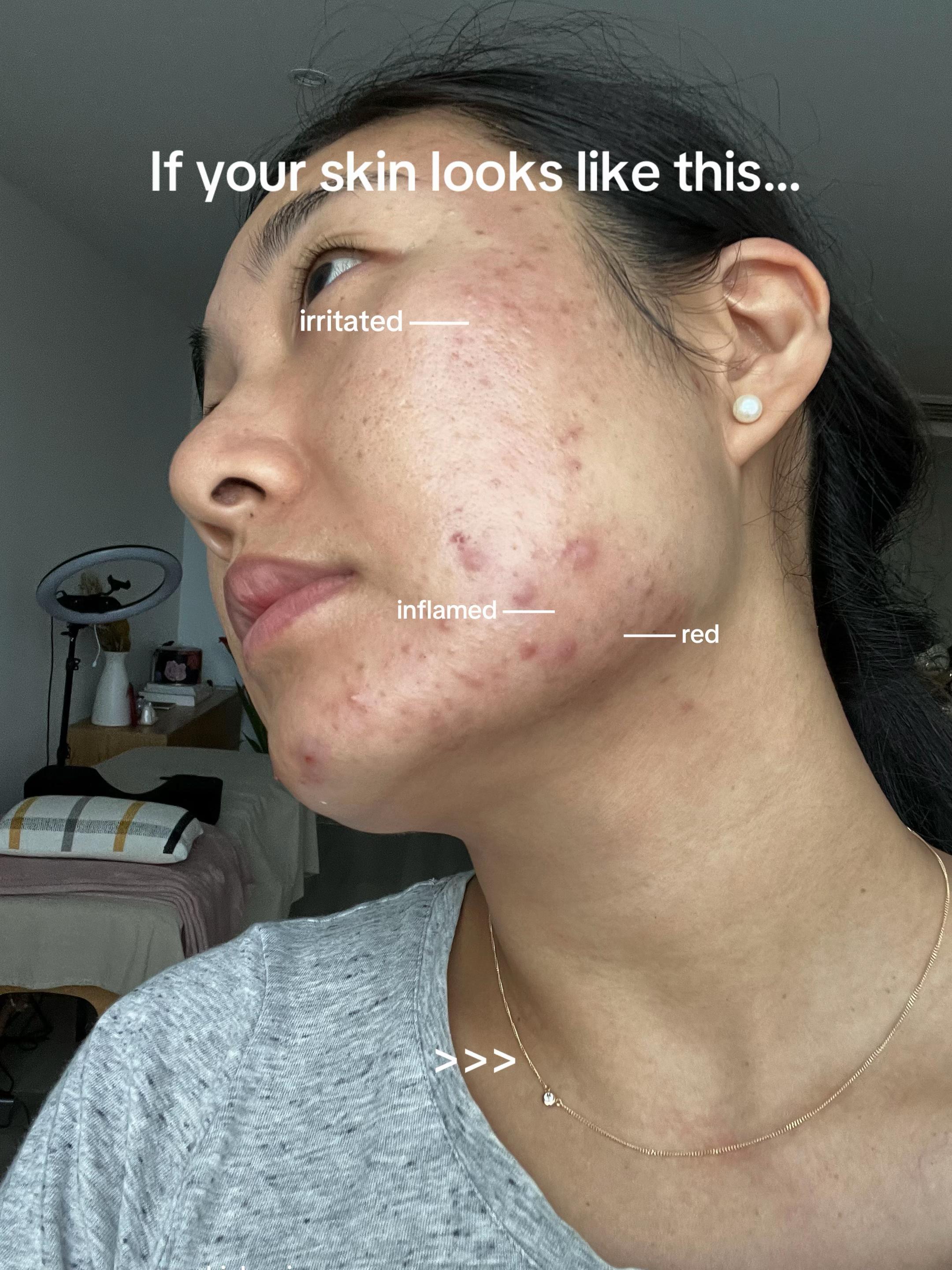@Lisa | acne → clear skin