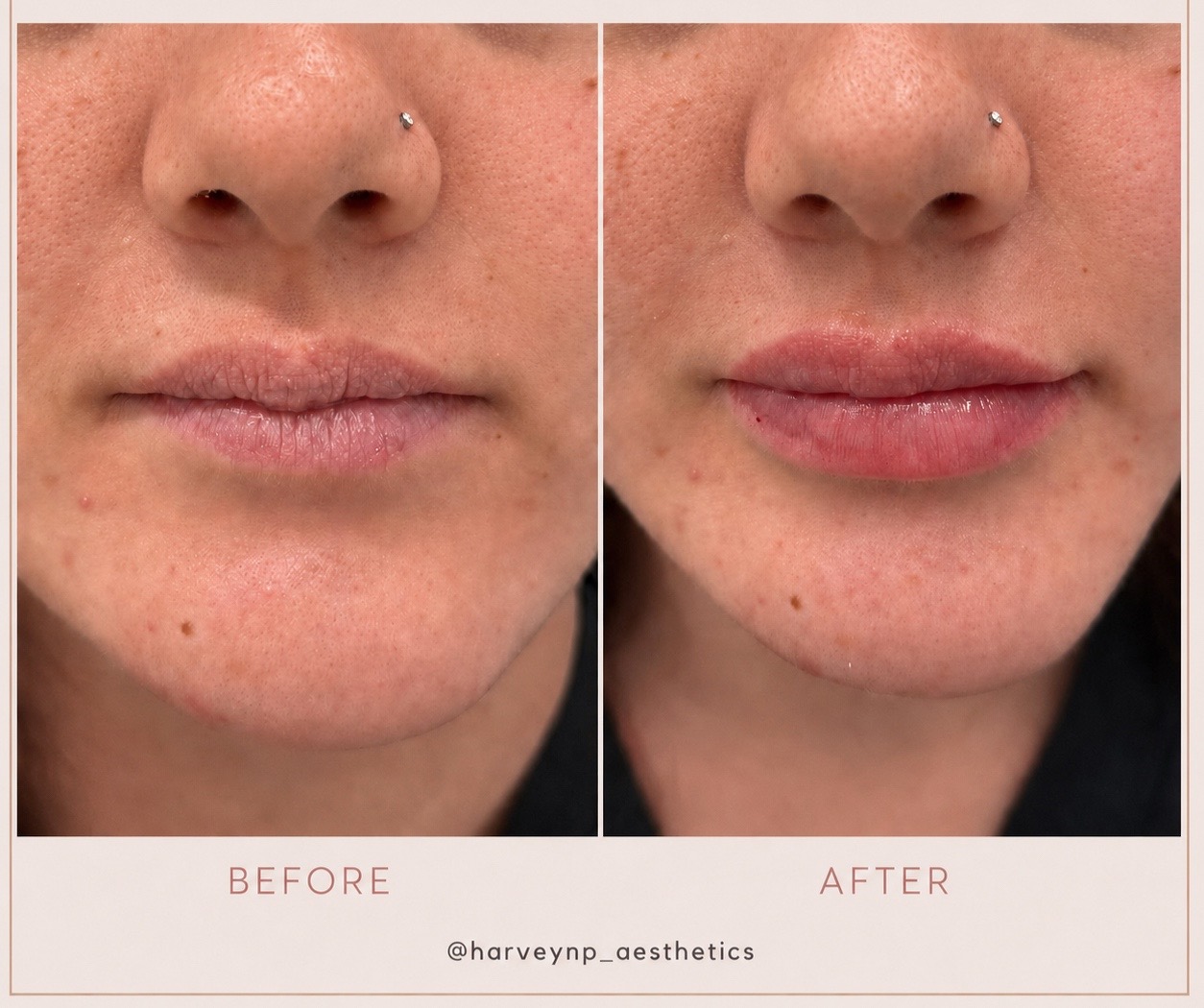 @HarveyAesthetics_NP