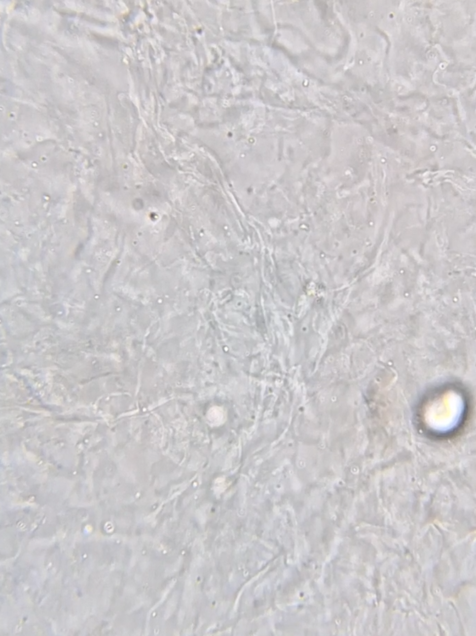 🔬 Filamentos de muco na urina: o que | analisesclinicasnapratica ...