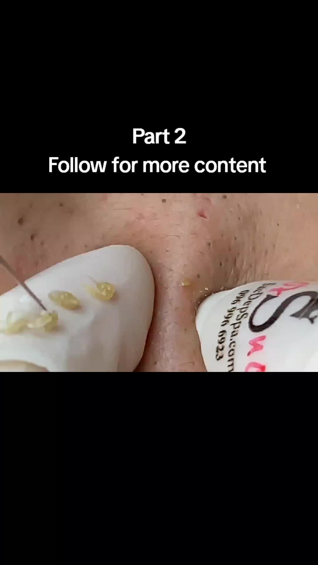 @Pimple Pooping