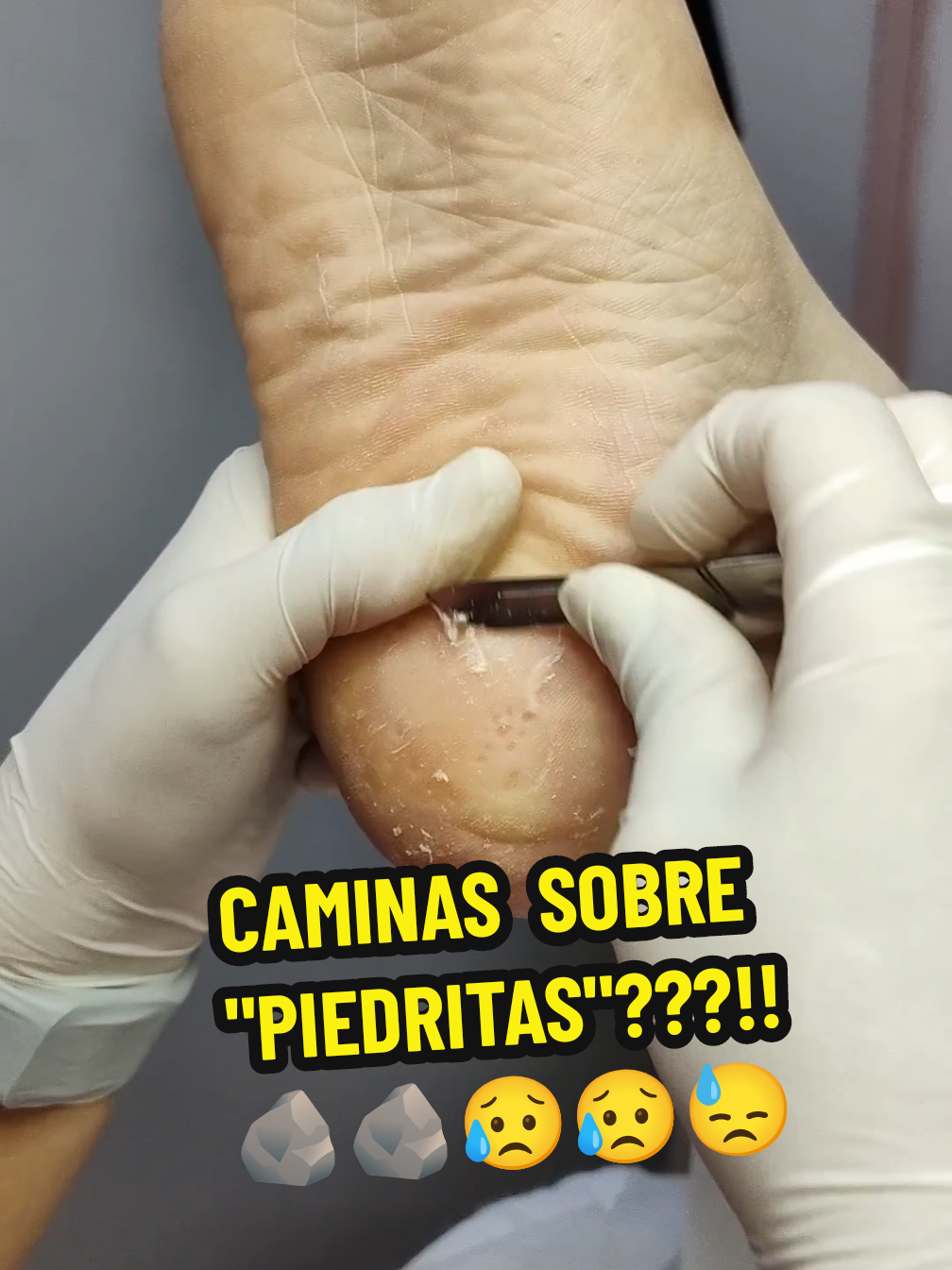 @podolog&iacute;a calzada