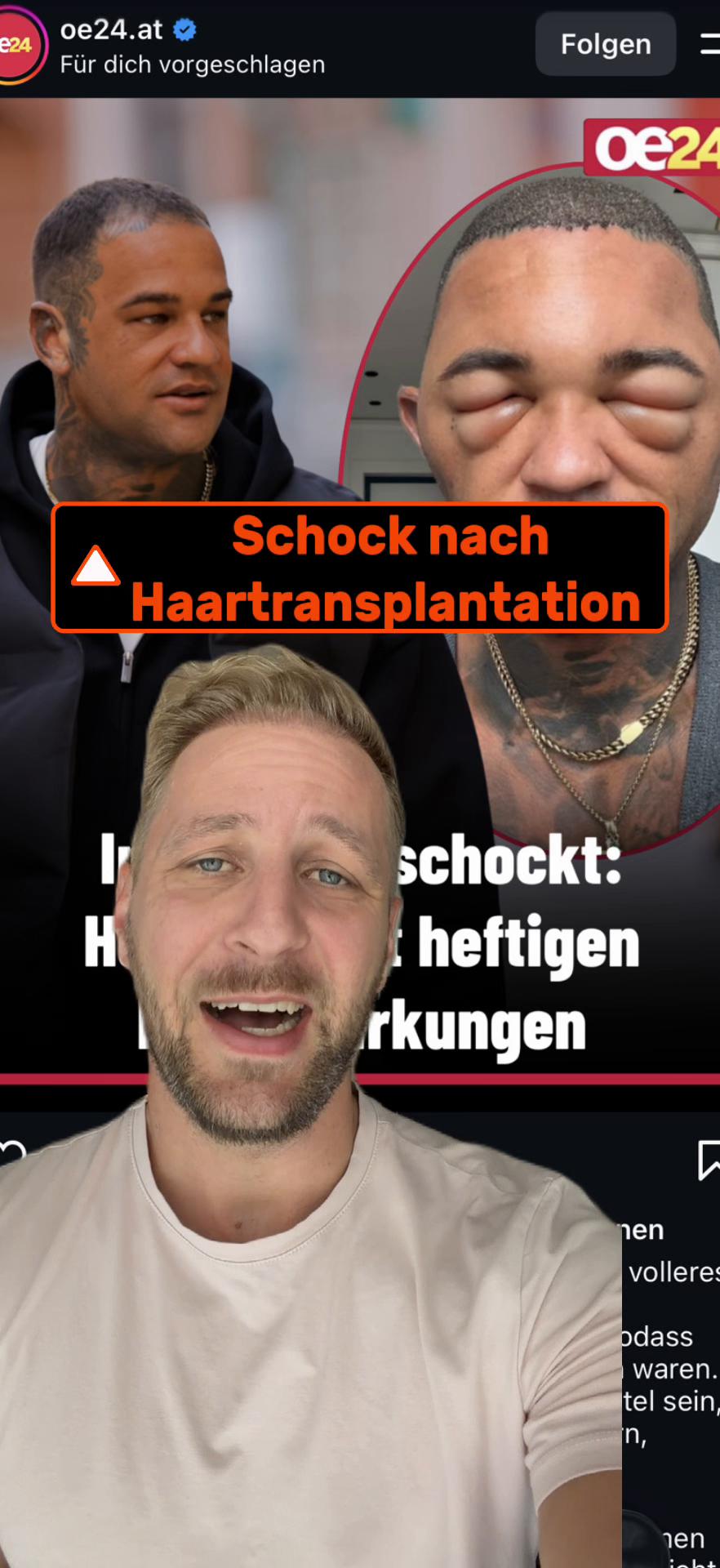 @Mr. Hairtransplant