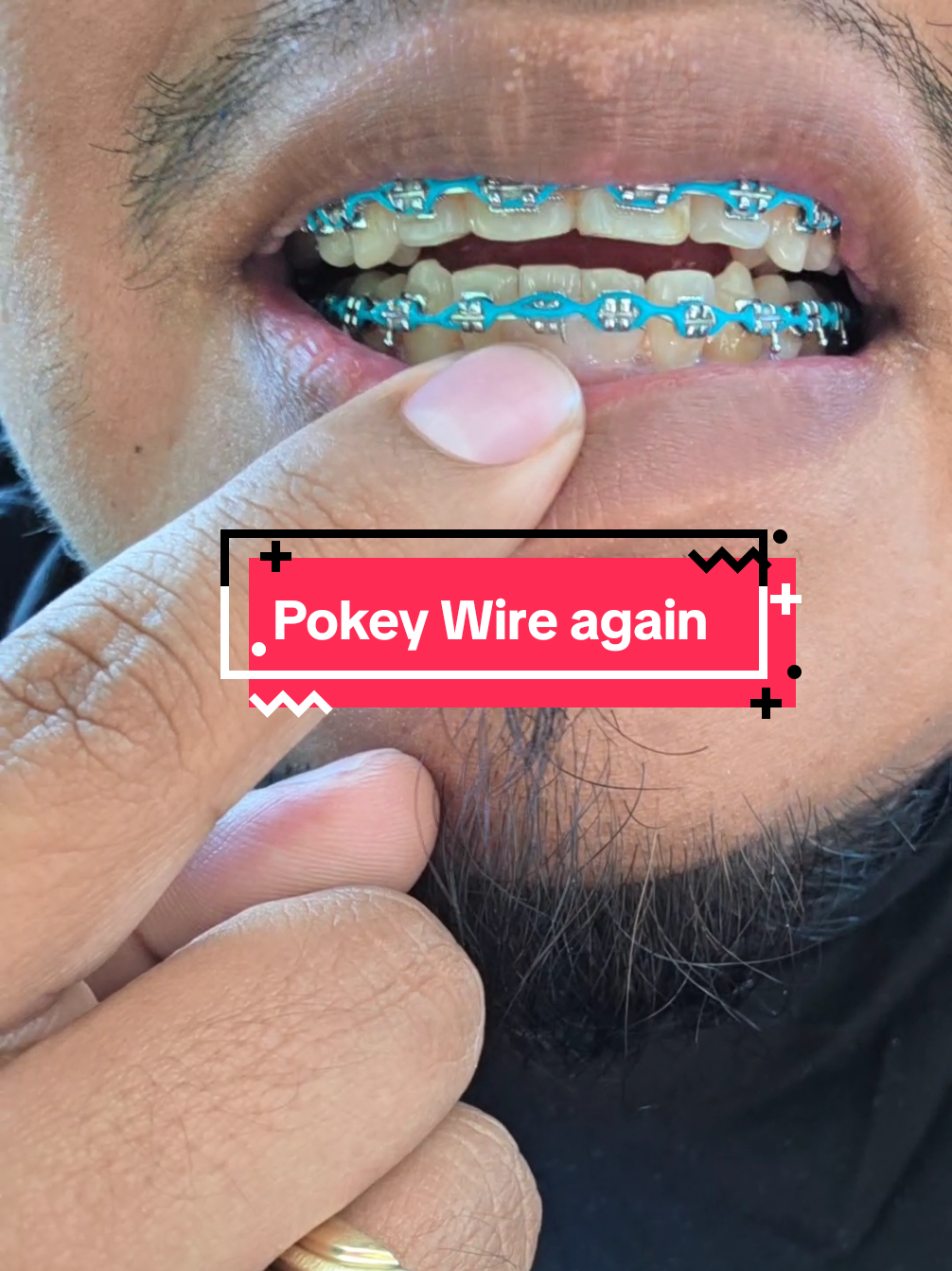 @str8braces