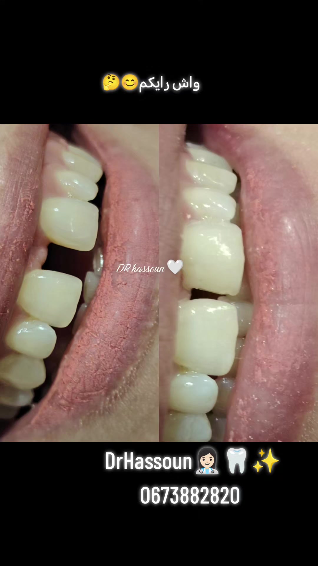 @Dr HASSOUN02 طبيبة الاسنان شلف