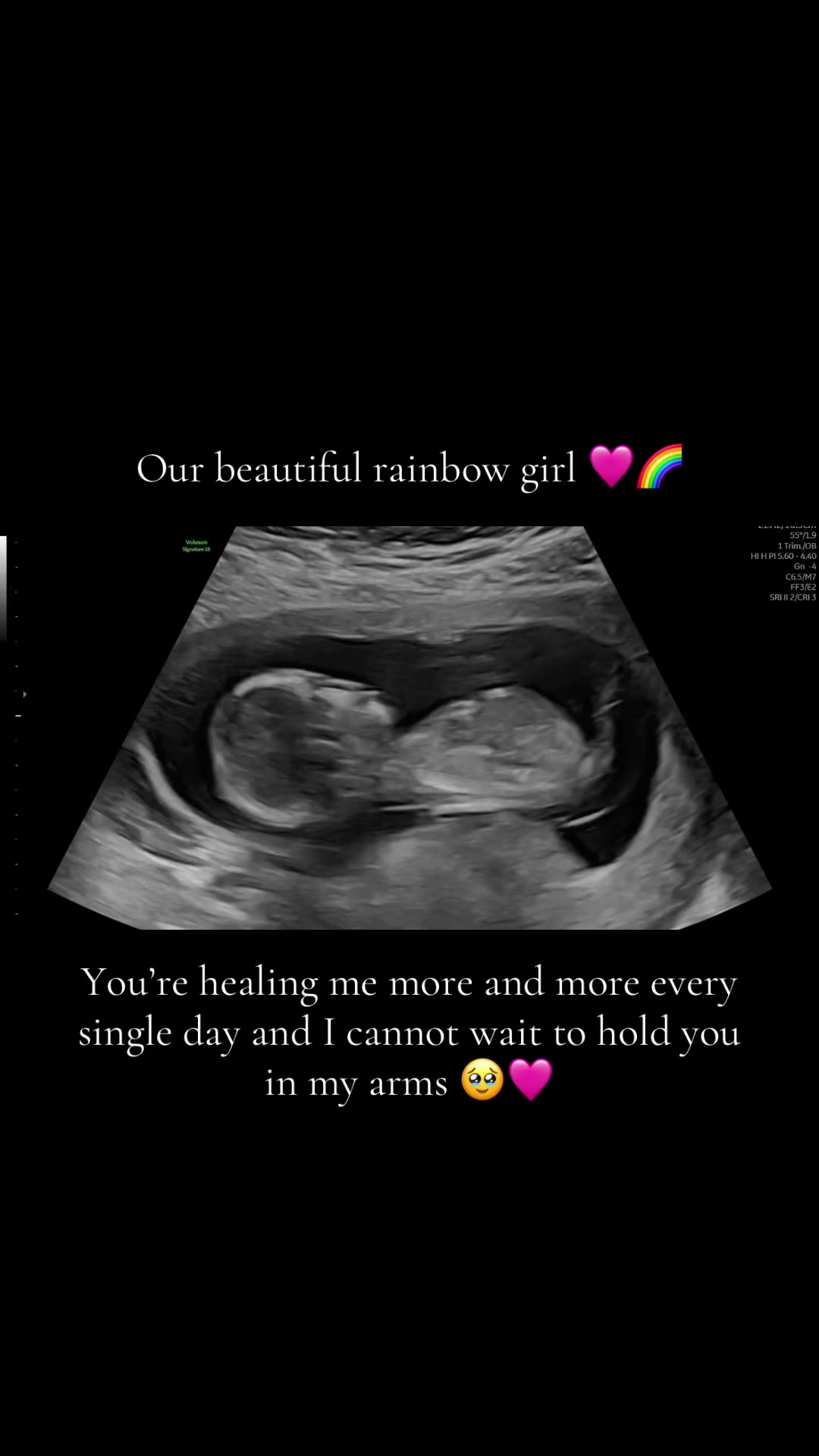 @Stacey🌸| Pregnancy after loss