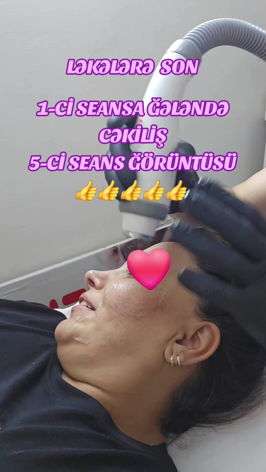 @ehmedli_kosmetoloq_lazeroloq