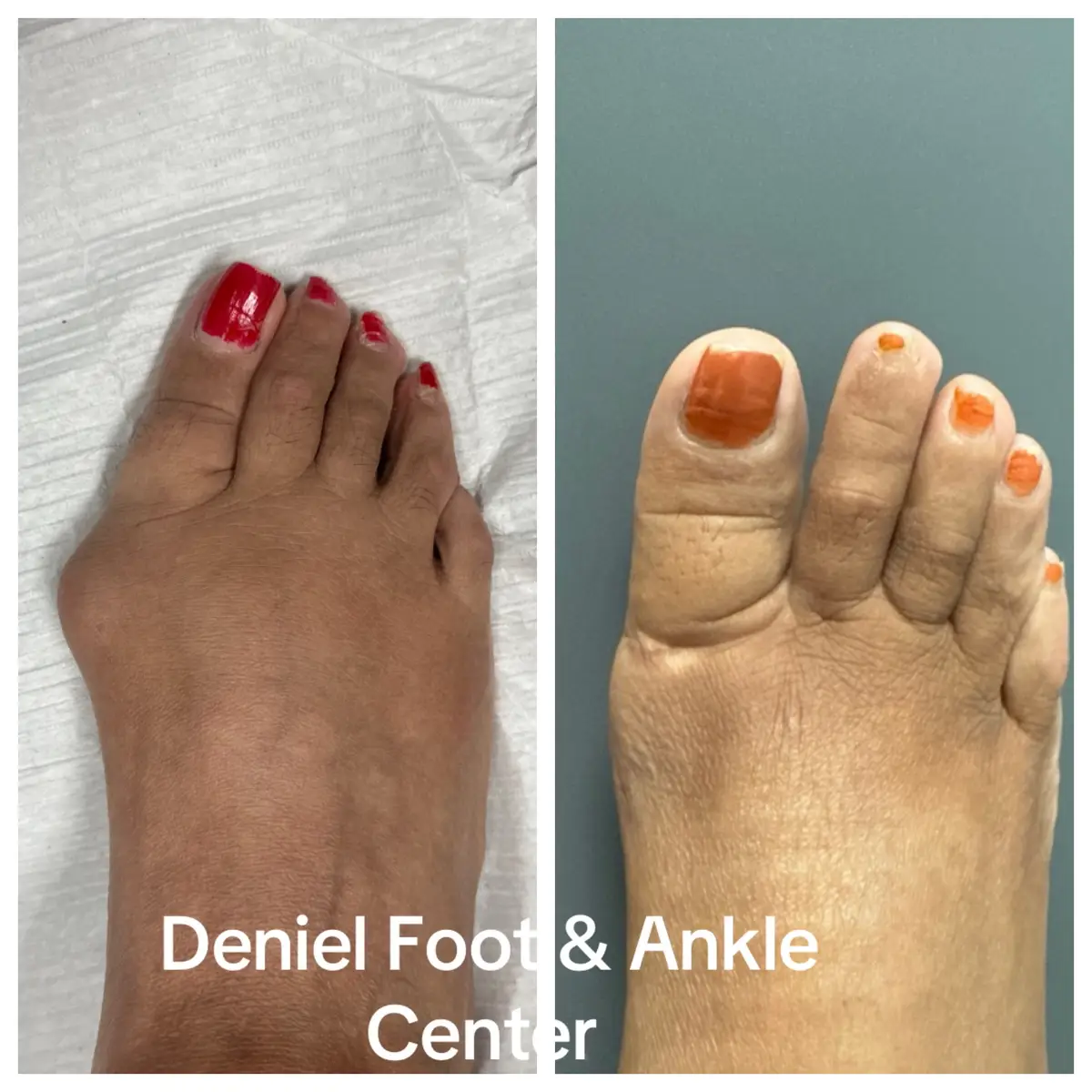 @Deniel Foot and Ankle Center