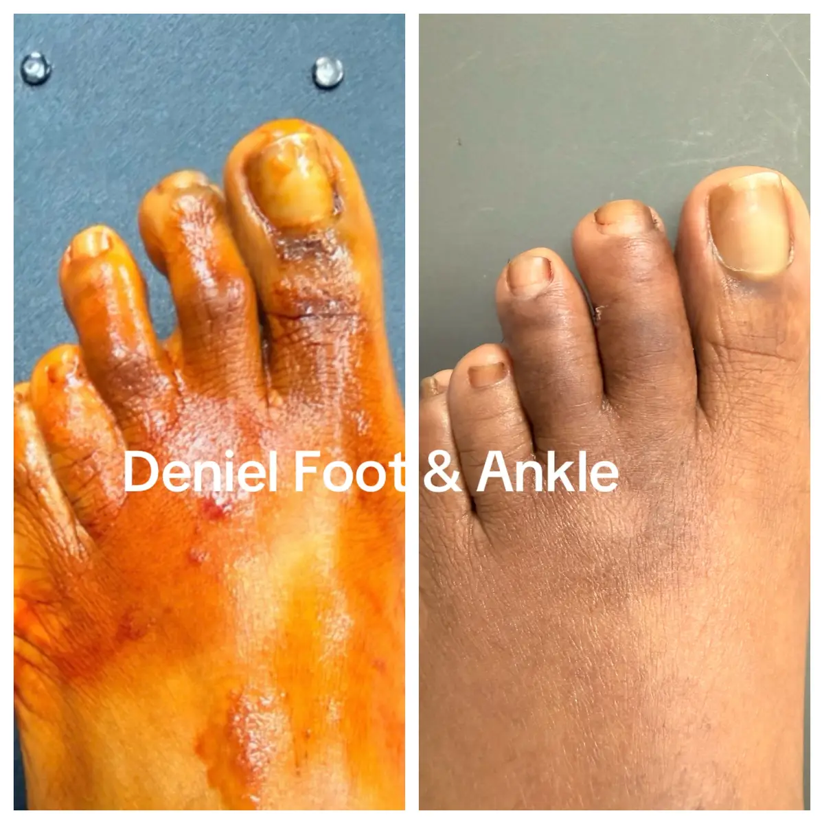 @Deniel Foot and Ankle Center