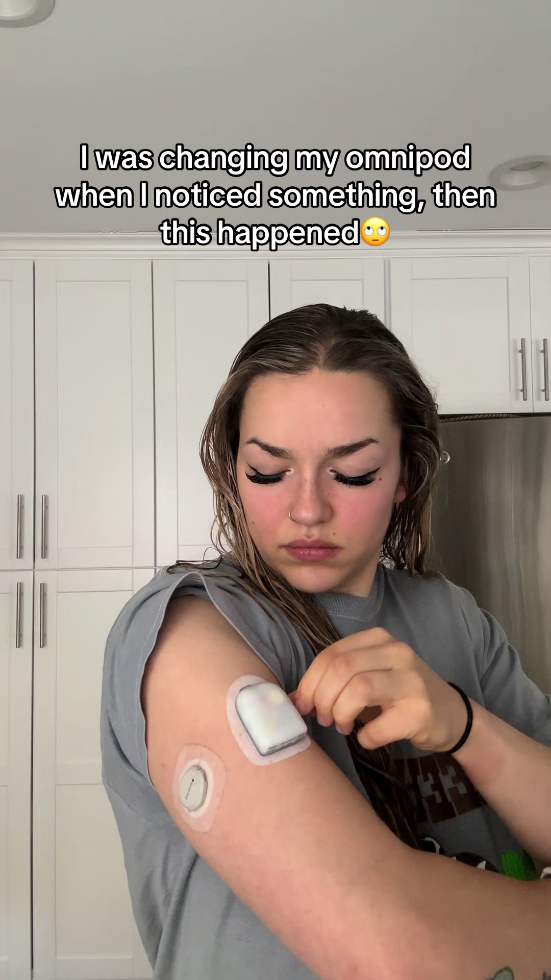 @TYPE&ensp;1&ensp;DEEABETES