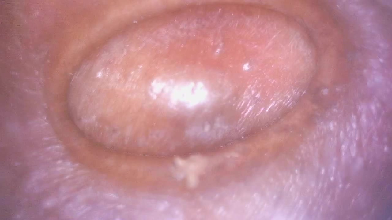 @PimplePopperz
