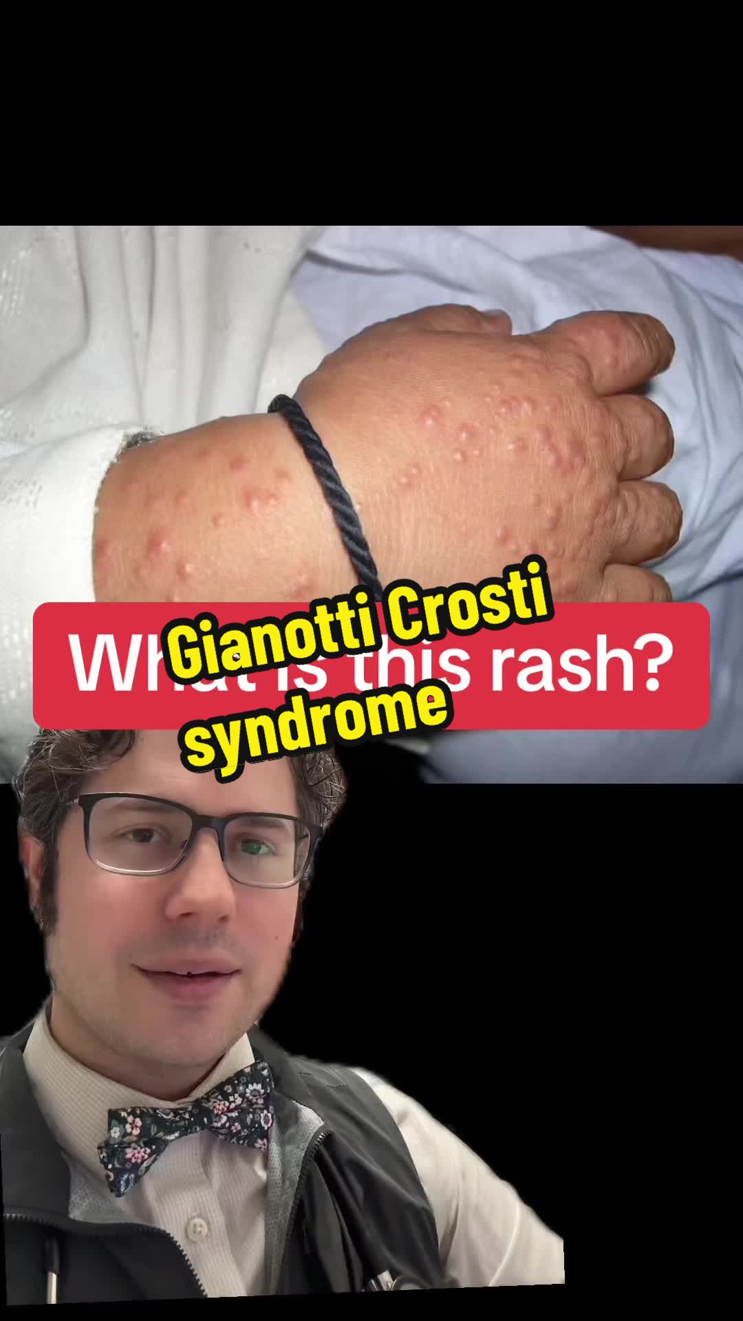 What is this rash? What is Gianotti | Dr. Rubin, MD (@rubin_allergy)