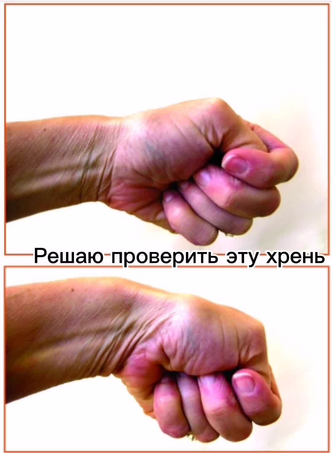 Сжимает кулачки и напрягается. Порванное сухожилие на большом пальце руки.
