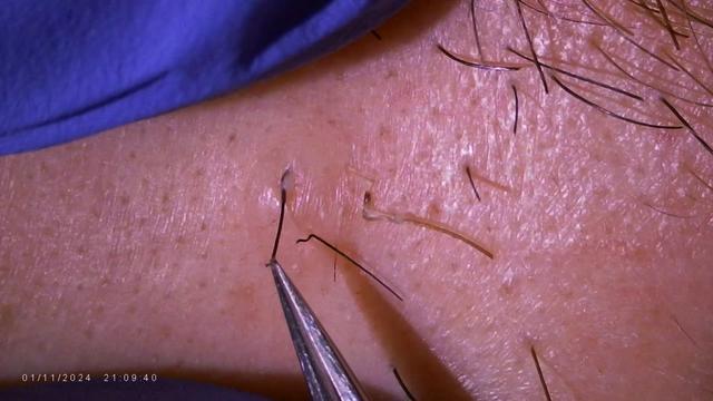 @Neurospice Beauty Electrolysis