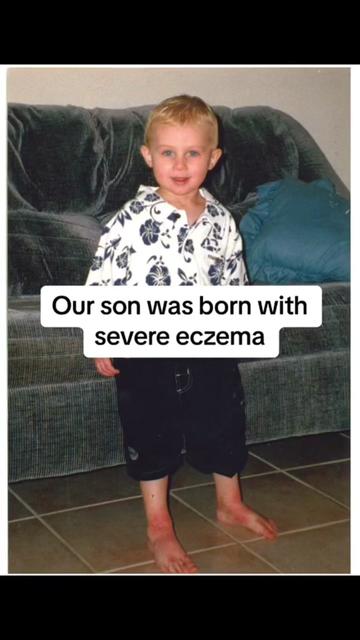 @Eczema Diaries USA & UK