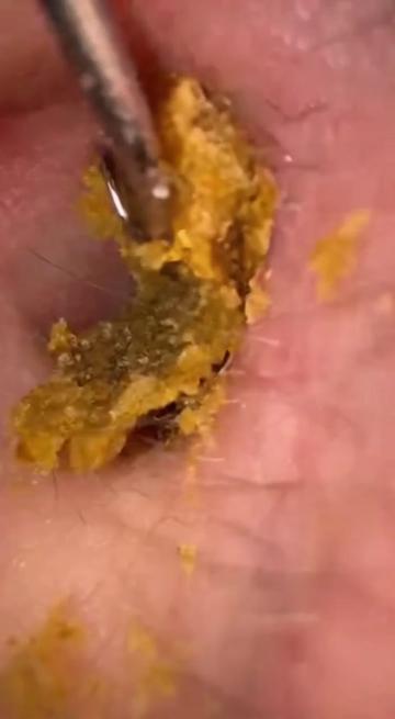 @Ear Cleaning