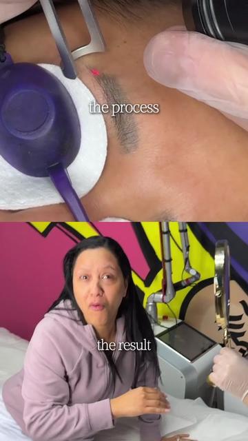 @Safe Eyebrows Tattoo Removal🗽