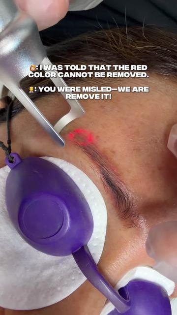 @Safe Eyebrows Tattoo Removal🗽