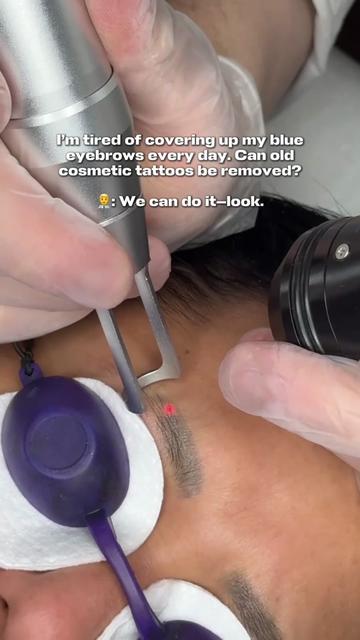 @Safe Eyebrows Tattoo Removal🗽
