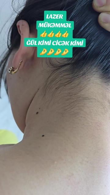 @ehmedli_kosmetoloq_lazeroloq