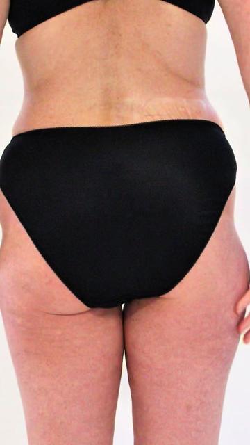 @Skinnies InstantLifts