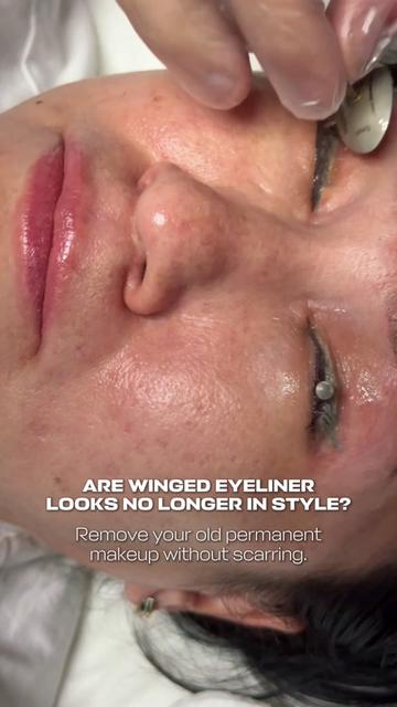 @Safe Eyebrows Tattoo Removal🗽