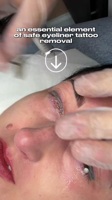 @Safe Eyebrows Tattoo Removal🗽
