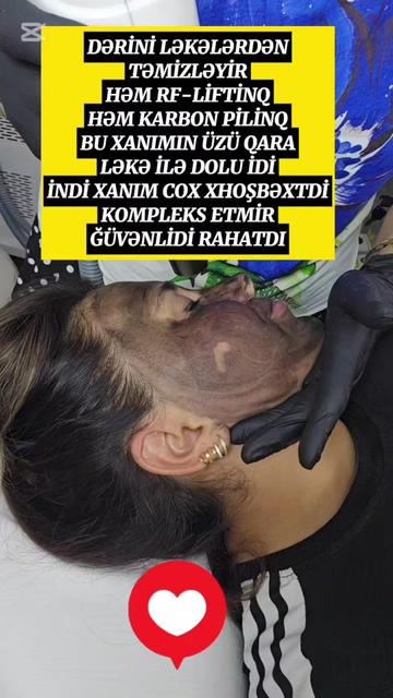 @ehmedli_kosmetoloq_lazeroloq