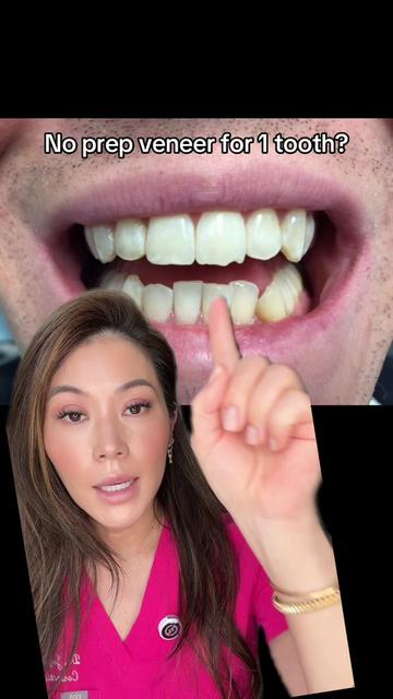 @Joycethedentist OC Veneers