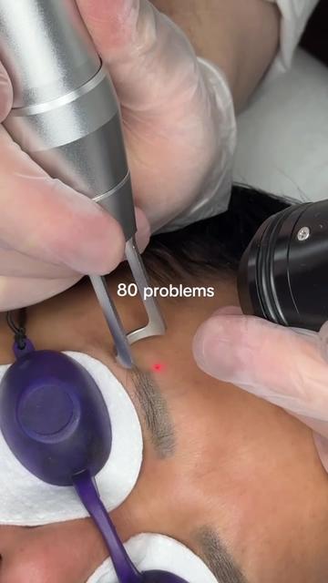 @Safe Eyebrows Tattoo Removal🗽