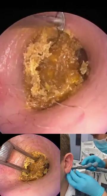 @Ear Cleaning