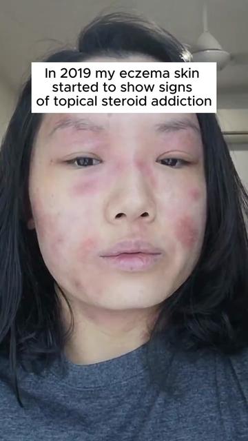 @Grace | TSW & Eczema Recovery