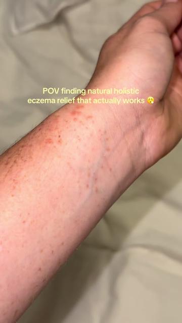 @Eczema Diaries USA & UK