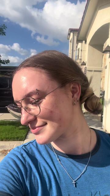 @Bay | Acne Baddie ✨