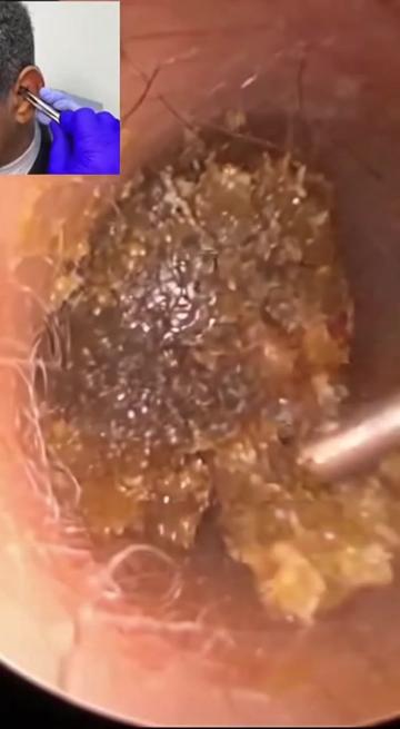 @Ear Cleaning