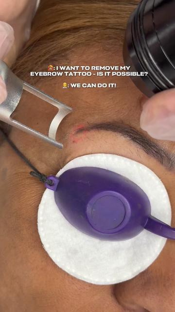 @Safe Eyebrows Tattoo Removal🗽