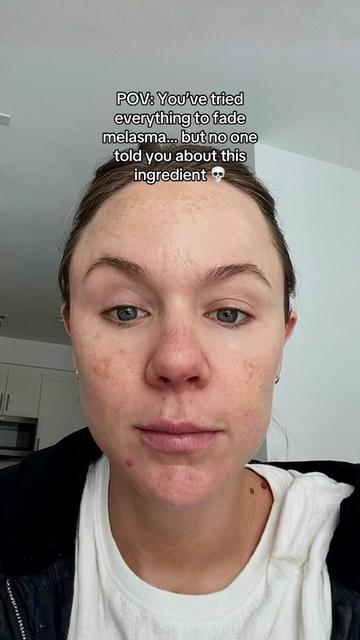 @Celeste | RN acne expert