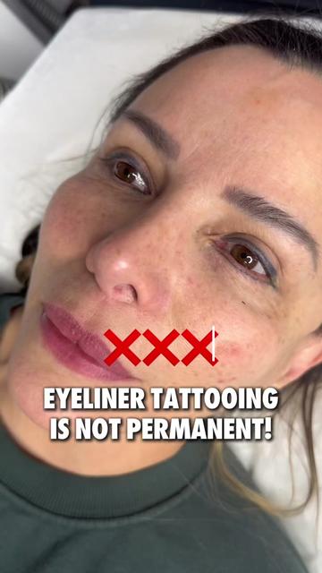 @Safe Eyebrows Tattoo Removal🗽