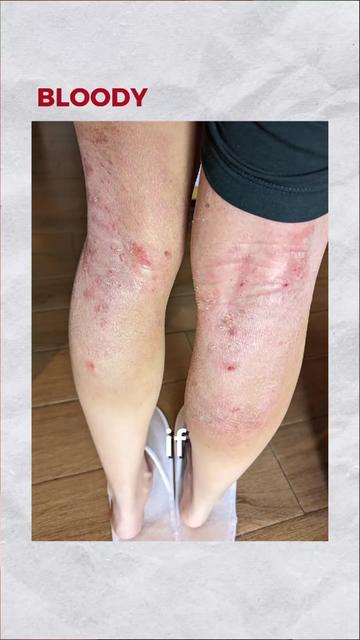 @Grace | TSW & Eczema Recovery