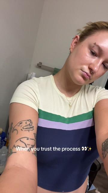 @Bay | Acne Baddie ✨
