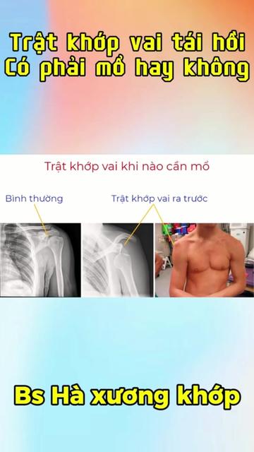 @Chuyên gia xương khớp