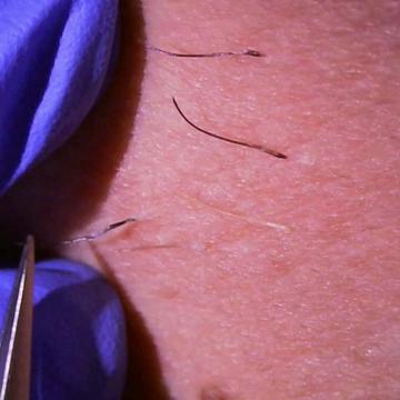 @Neurospice Beauty Electrolysis