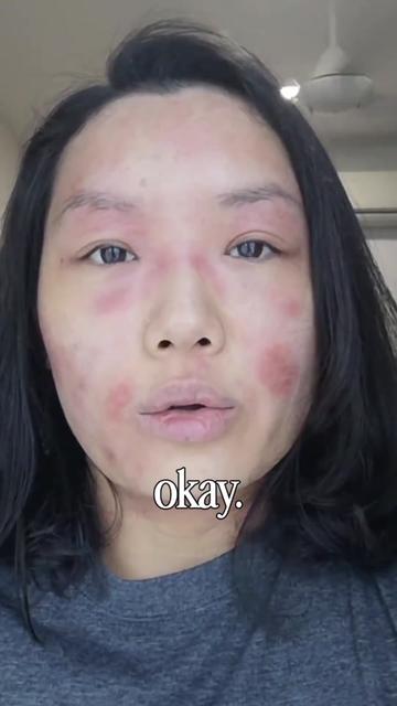 @Grace | TSW & Eczema Recovery